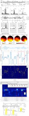 Commentary: Is So-Called “Split Alpha” in EEG Spectral Analysis a Result of Methodological and Interpretation Errors?